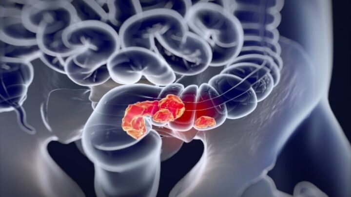 Médicament contre le cancer du rectum : une "réponse clinique sans précédent" 2 Cancer rectal