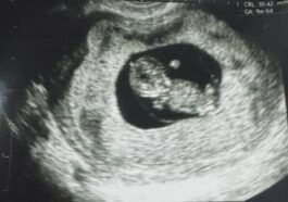 Né le premier enfant grâce à Fertilo, une technique alternative à la fécondation in vitro : comment ça fonctionne 5 Échographie de l'enfant né par Fertilo. Crédit : Gameto