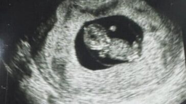 Né le premier enfant grâce à Fertilo, une technique alternative à la fécondation in vitro : comment ça fonctionne 10 Échographie de l'enfant né par Fertilo. Crédit : Gameto