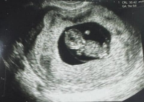 Découvrez les avantages de Fertilo, la méthode alternative à la FIVET qui a donné naissance au premier bébé ! 3 Échographie de l'enfant né avec Fertilo. Crédit : Gameto