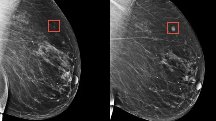 Nouveau test utilise l'IA pour détecter le cancer du sein à ses débuts les plus précoces 1 Ilustração de deteção do cancro da mama com recuso à Inteligência Artificial