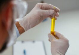 Un nouveau examen urinaire pourrait détecter les premiers signes de cancer du poumon des années avant les symptômes / Photo iStock