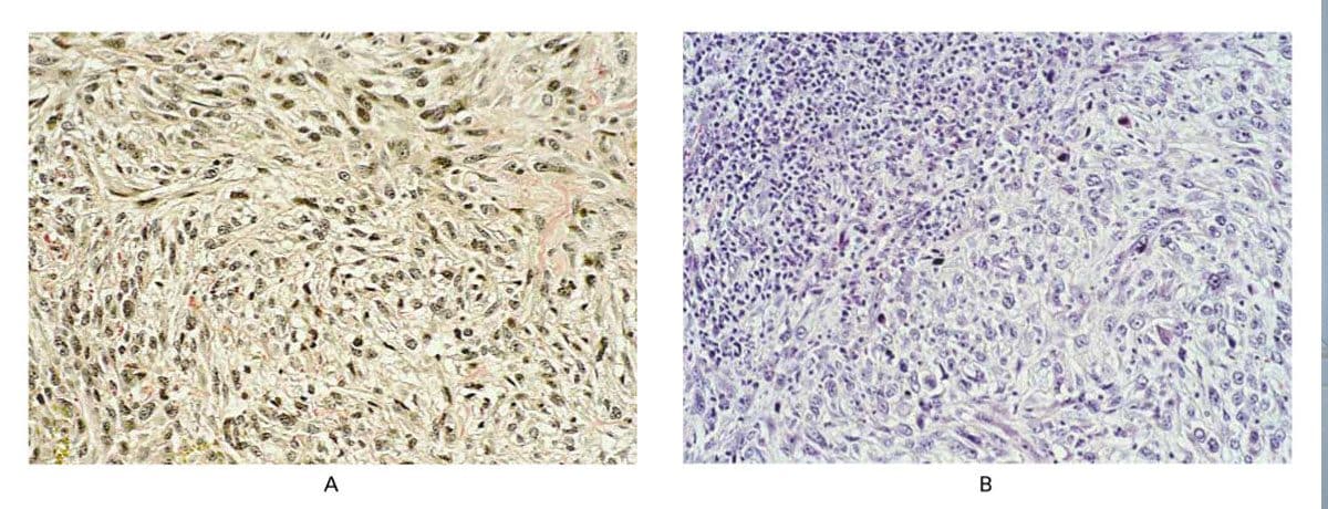La tumeur du patient (A) et celle du chirurgien (B) étaient toutes deux des histiocytomes fibroses malins, dont les cellules cancéreuses étaient génétiquement identiques / Crédit NEJM
