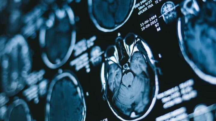 Le plus grand et le plus solide des études révèle 15 facteurs augmentant le risque de démence précoce 1 Le plus grand et le plus solide des études révèle 15 facteurs augmentant le risque de démence précoce