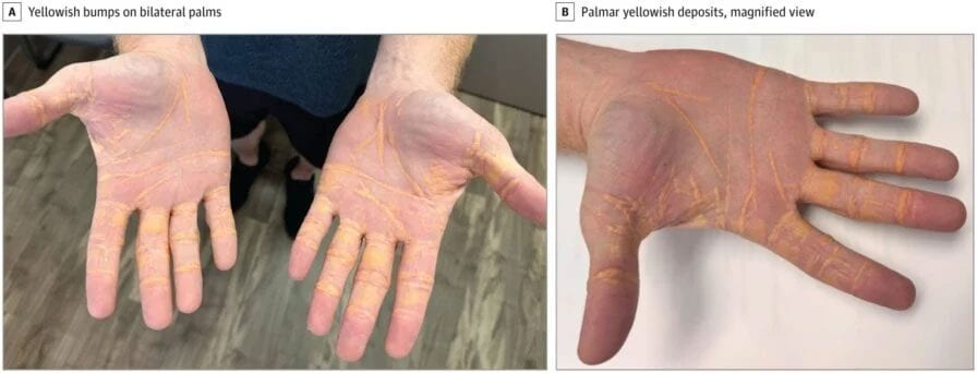 Il mange autant de viande, de fromage et de beurre pendant 8 mois, le cholestérol s'échappe de ses mains 3 Les "nodules jaunâtres" sur les mains de l'homme, apparus aussi sur les coudes / Marmagkiolis et al. JAMA Cardiology