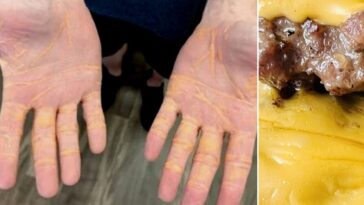 Il mange autant de viande, de fromage et de beurre pendant 8 mois, le cholestérol s'échappe de ses mains 15 Image