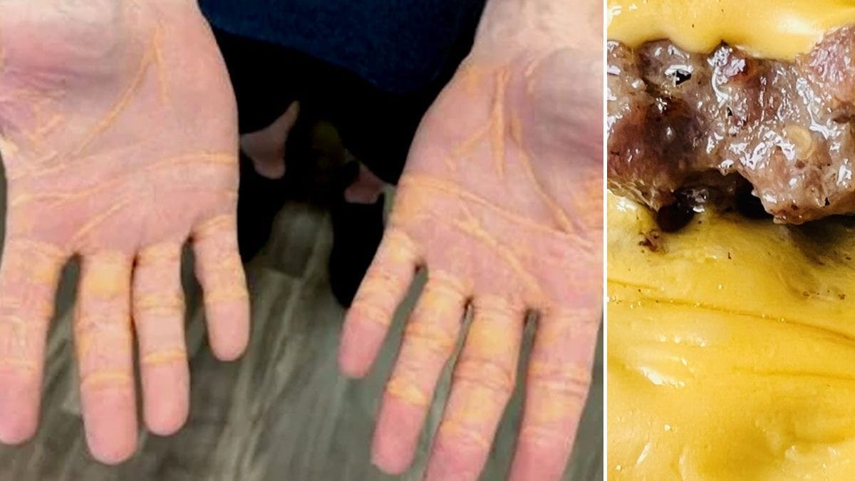 Il mange autant de viande, de fromage et de beurre pendant 8 mois, le cholestérol s'échappe de ses mains 2 Image