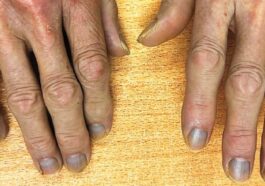 Un patient se présente à l'hôpital avec une étrange peau grise : un mystère clinique d'argyrisme à Hong Kong 91 Les doigts gris de l'homme touché par l'argirie. Crédit : The New England Journal of Medicine