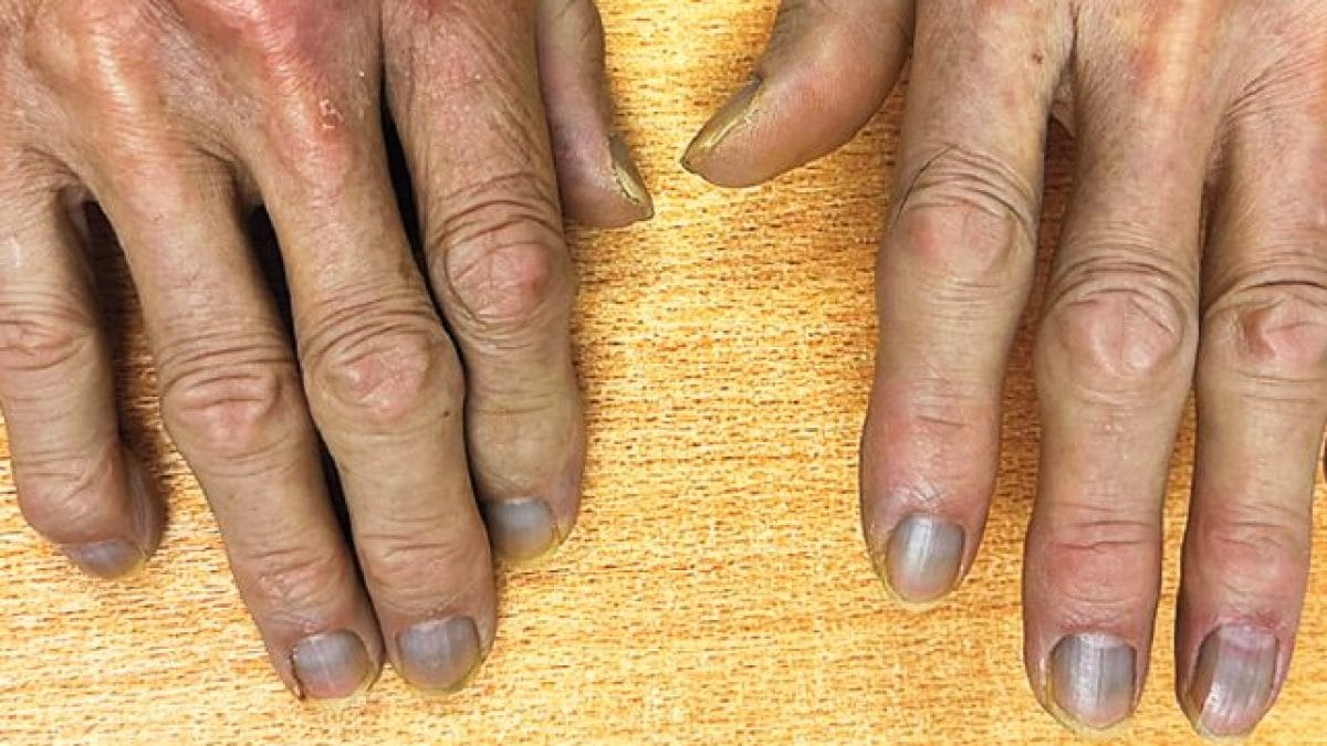 Un patient se présente à l'hôpital avec une étrange peau grise : un mystère clinique d'argyrisme à Hong Kong 2 Les doigts gris de l'homme touché par l'argirie. Crédit : The New England Journal of Medicine