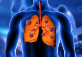 Le cancer du poumon augmente chez les non-fumeurs et une raison potentielle émerge