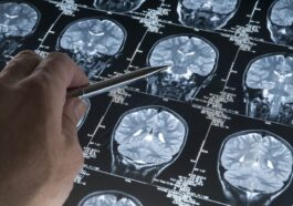 Découverte de la possible cause de l'Alzheimer : une révolution pour la prévention et le traitement 50 Image