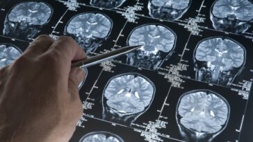 Découverte de la possible cause de l'Alzheimer : une révolution pour la prévention et le traitement 7 Image