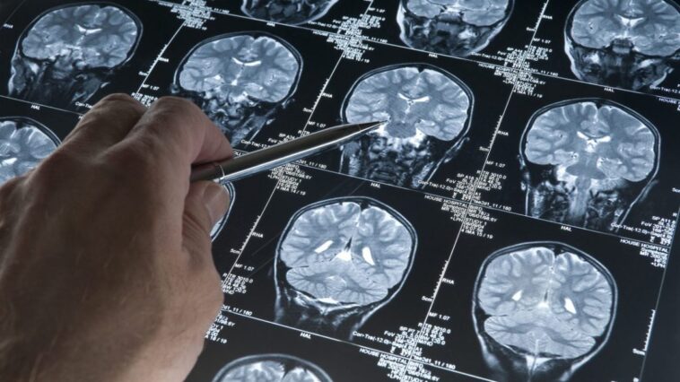 Découverte de la possible cause de l'Alzheimer : une révolution pour la prévention et le traitement 1 Image