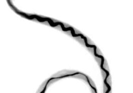 Elle pensait avoir un décalage horaire, mais elle avait des larves de parasite dans le cerveau : cas clinique d'une femme 18 Angiostrongylus cantonensis. Credit: Wikipedia