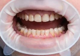 Et si la cause de la maladie d'Alzheimer se cachait dans votre bouche ?