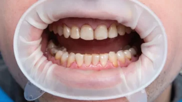 Et si la cause de la maladie d'Alzheimer se cachait dans votre bouche ? 6 Et si la cause de la maladie d'Alzheimer se cachait dans votre bouche ?
