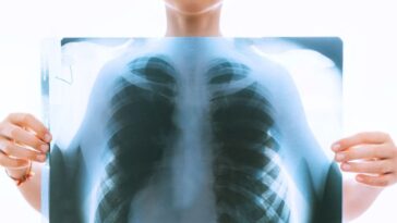 Que se cache derrière l’augmentation des cas de cancer du poumon chez les non-fumeurs ? 4 Image