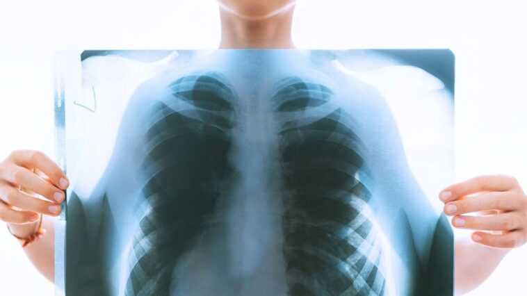 Que se cache derrière l’augmentation des cas de cancer du poumon chez les non-fumeurs ? 1 Image