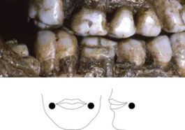 I segni di usura osservati sui denti suggeriscono l’uso di piercing alle guance già dall’infanzia / Credit John Willman