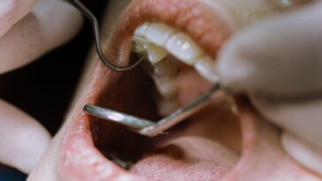 Une nouvelle étude révèle des aliments "inattendus" responsables des caries : attention, ce n'est pas que le sucre ! 16 Image
