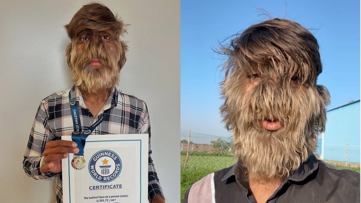 La vie de Lalit, le garçon au visage le plus poilu du monde : découvrez la syndrome du loup-garou 2 INSTAGRAM | Photo du profil Instagram de Lalit Patidar