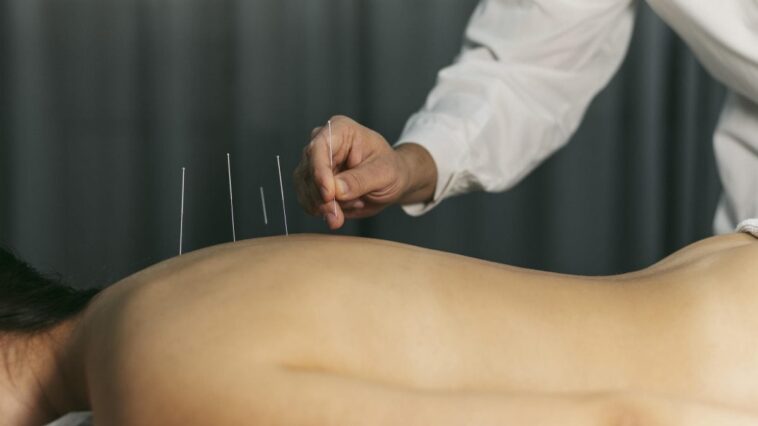 L'acupuncture remboursée par la sécurité sociale : qu'est-ce que c'est, quels en sont les bienfaits et quel est le prix des séances ? 1 Image