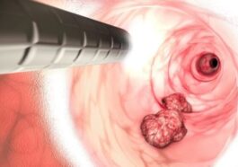 Un cancer en forte hausse chez les jeunes