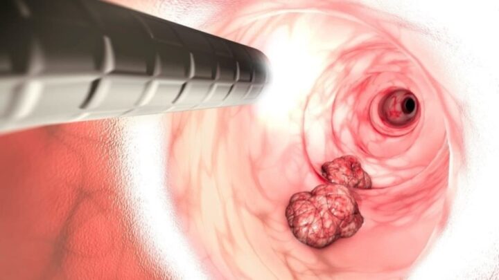 Un cancer en forte hausse chez les jeunes 1 Un cancer en forte hausse chez les jeunes