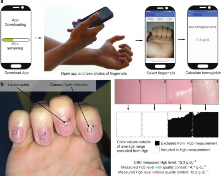 Une application basée sur l'IA détecte une maladie du sang grâce à une photo des ongles 3 Détection d'anémie via une application IA. Source: Mannino, R.G., Myers, D.R., Tyburski, E.A. et al.