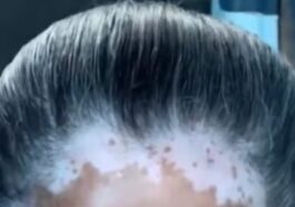 La storia di Lana, la bambina di Gaza a cui sono diventati i capelli bianchi dopo un bombardamento israeliano