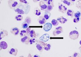 Naegleria fowleri, un'ameba mangia-cervello nel liquido cerebrospinale / Credit: James Roberts/Children's Healthcare di Atlanta