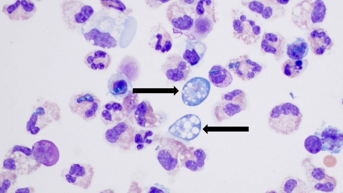 Tuée par une amibe mangée-cerveau après un lavage nasal, les symptômes en quelques jours ne lui ont laissé aucune chance 51 Naegleria fowleri, un'ameba mangia-cervello nel liquido cerebrospinale / Credit: James Roberts/Children's Healthcare di Atlanta