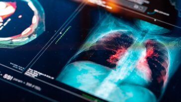 Une nouvelle thérapie combinée rend le cancer du poumon avancé opérable dans 3 cas sur 4 23 Immagine