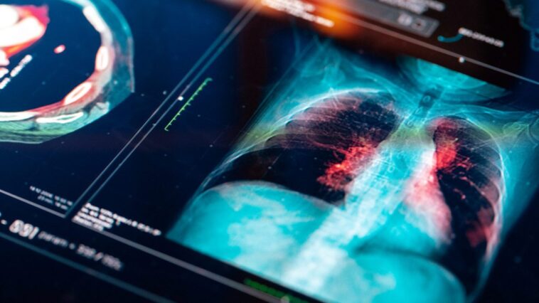 Une nouvelle thérapie combinée rend le cancer du poumon avancé opérable dans 3 cas sur 4 1 Immagine