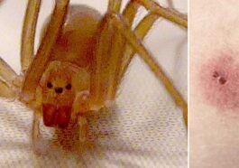 Un ragno violino (Loxosceles rufescens) et l’aspect d’une lésion cutanée causée par un de ses mors