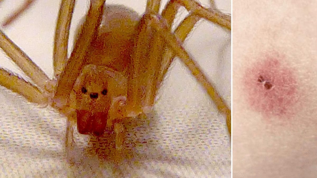 Comment identifier une morsure d'araignée violon, les symptômes à surveiller et les signes de danger 2 Une araignée violon (Loxosceles rufescens) et l’aspect d’une lésion cutanée causée par une morsure