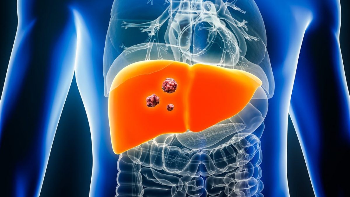 Foie en danger : explosion des cas dans 25 ans, découvrez les causes et les moyens de prévenir ce cancer 2 Image
