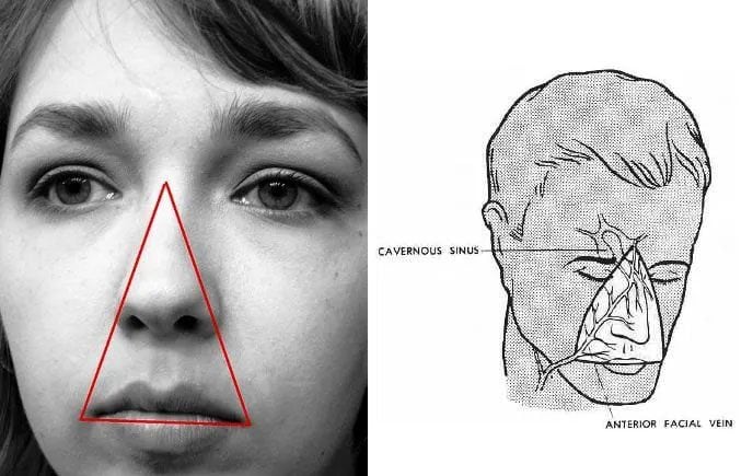Le 'triangle de la mort' ou triangle de danger sur le visage est l'aire comprise entre le pont du nez et les coins de la bouche / Crédit : Wikipedia