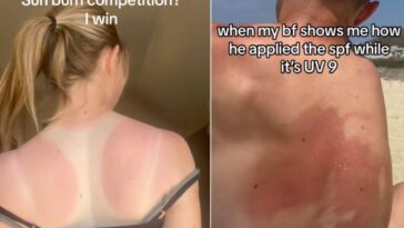 Concours de brûlures : pourquoi les vidéos du défi des coups de soleil sont vraiment périlleuses 18 Image