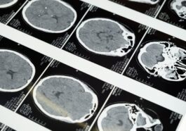 Pourquoi le sujet de la maladie de la vache folle refait surface après le décès d'un homme à Padoue : les hypothèses sur les causes 101 Image