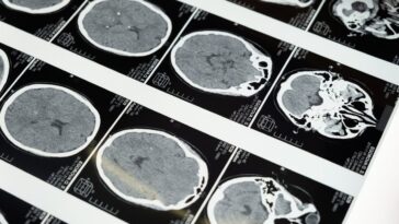 Pourquoi le sujet de la maladie de la vache folle refait surface après le décès d'un homme à Padoue : les hypothèses sur les causes 25 Image