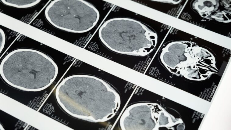 Pourquoi le sujet de la maladie de la vache folle refait surface après le décès d'un homme à Padoue : les hypothèses sur les causes 1 Image