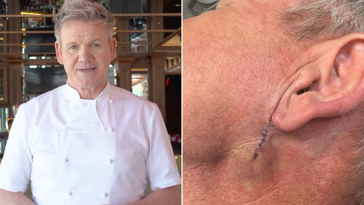 Qu'est-ce que le carcinome basocellulaire retiré à Gordon Ramsay : comment identifier le type de cancer de la peau le plus fréquent 2 INSTAGRAM | Photo du profil de Gordon Ramsay (@gordongram)
