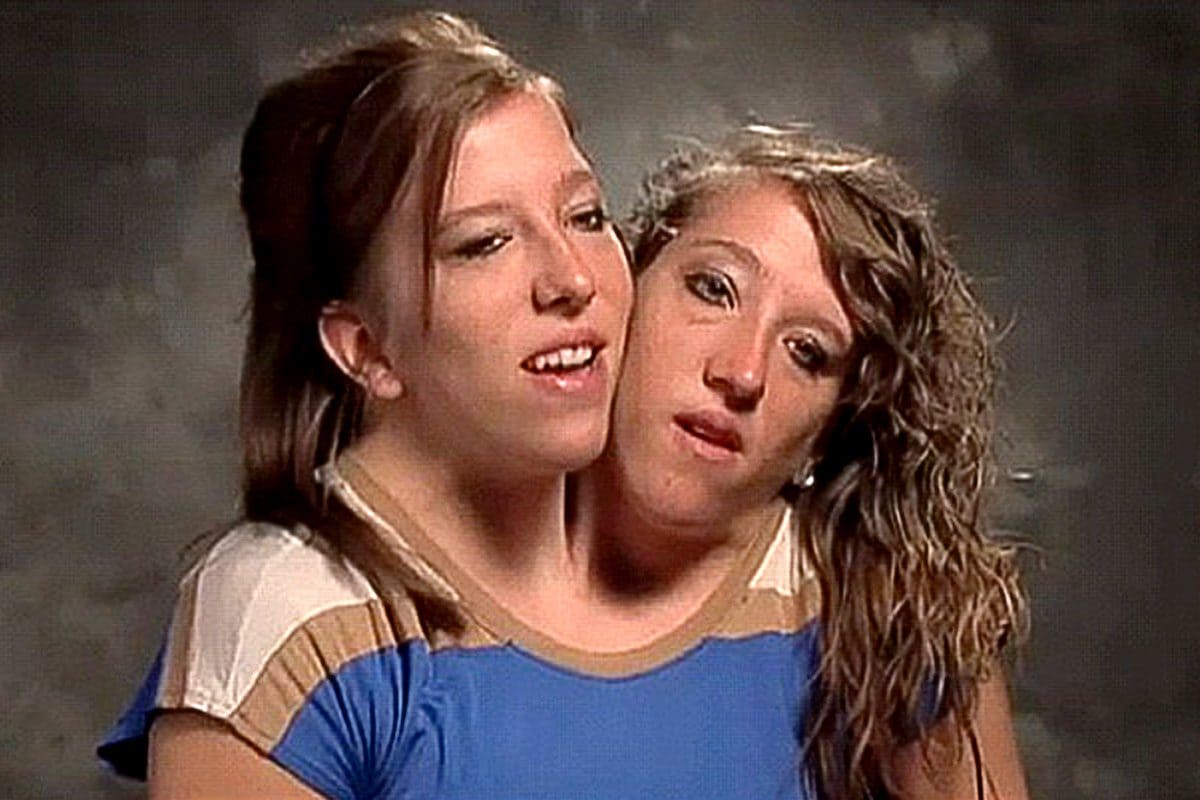 Abby et Brittany Hansel : la vie fascinante des sœurs siamoises à deux têtes et un seul corps 3 Les jumelles siameses Abby et Brittany Hansel / TLC