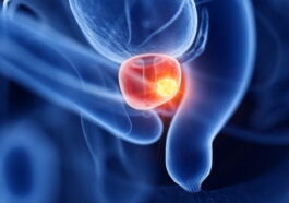 Test rapide et économique pour diagnostiquer le cancer de la prostate
