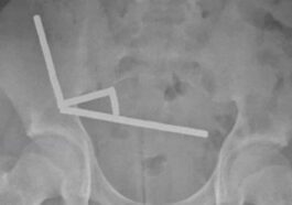 La radiographie montre les aimants au néodyme dans l'abdomen de l'adolescent.