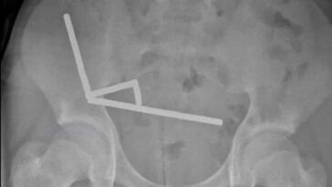 La radiographie montre les aimants au néodyme dans l'abdomen de l'adolescent.