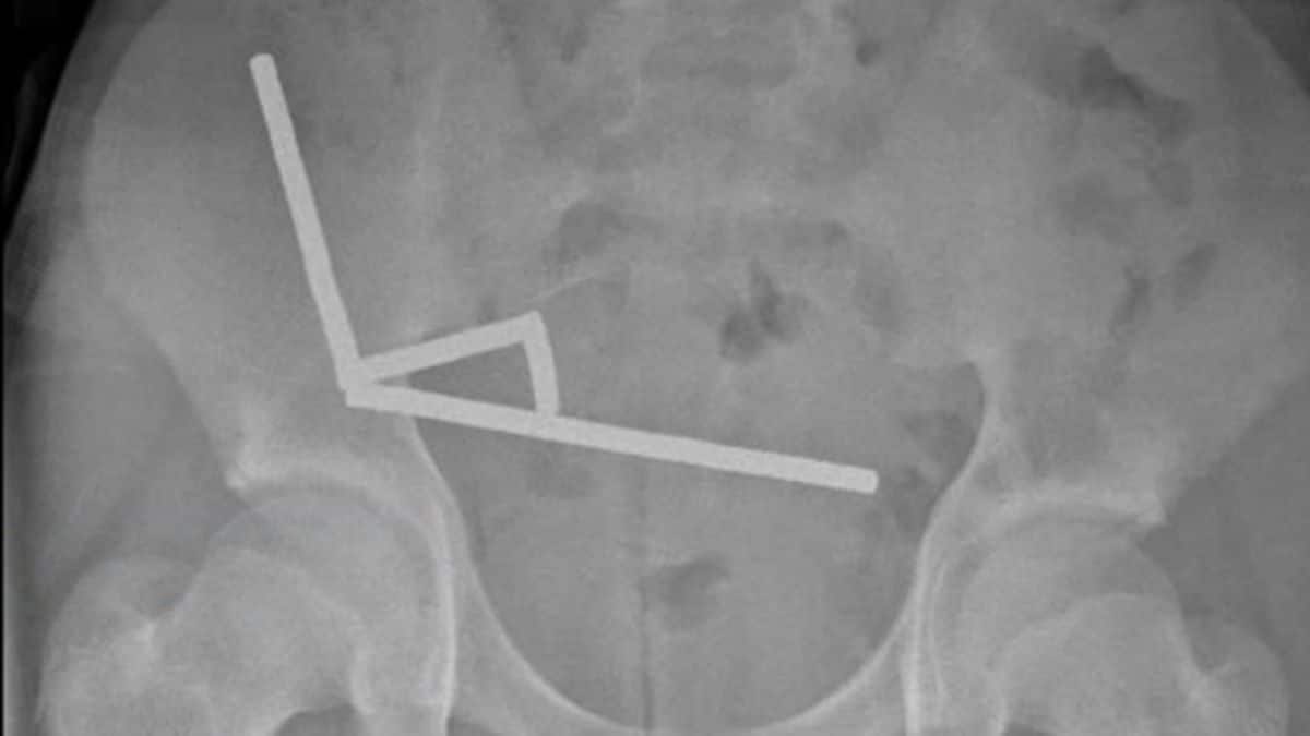 Ingestion de 200 aimants : un adolescent hospitalisé avec des douleurs intenses après une intervention chirurgicale sur son intestin 2 La radiographie montre les aimants au néodyme dans l'abdomen de l'adolescent.
