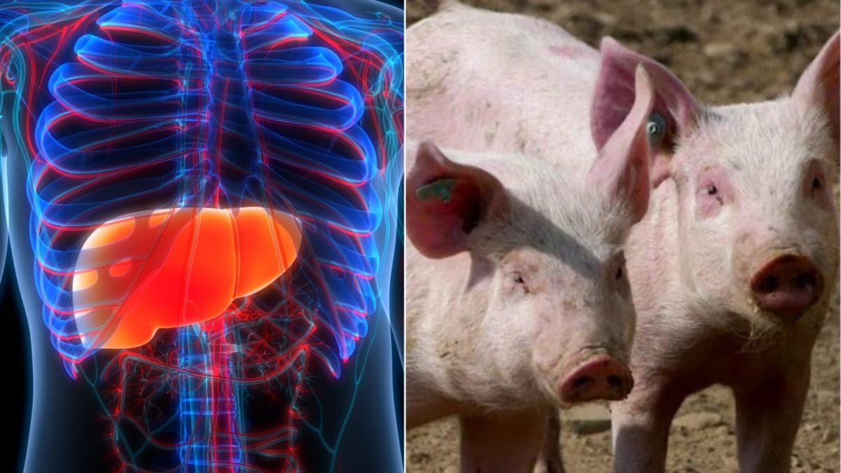 Le premier succès d'une greffe de foie de porc sur un homme vivant 2 Image