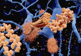 Un signal cellulaire peut induire l'agrégation de peptides de bêta-amiloïde (en jaune) dans le cerveau, accélérant la formation de plaques amyloïdes typiques de l'Alzheimer / Crédit : iStock